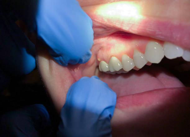 Best Emergency Wisdom Teeth Removal in Garrett, TX